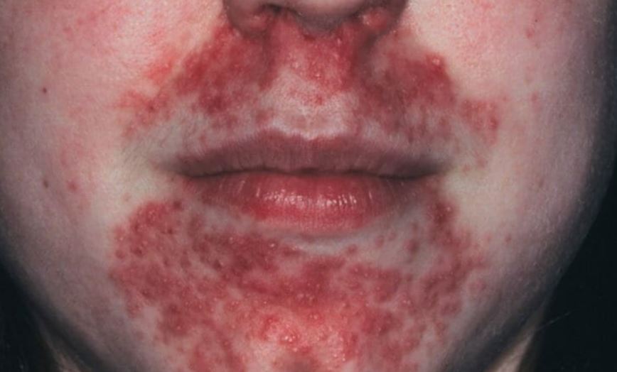 Lip Rash Causes, Pictures, On Upper and Treatments – Healthality