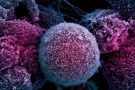 Microscopic view of human cancer cells showing irregular shapes and clustered growth, illustrating the cellular impact of the 2026 cancer epidemic.